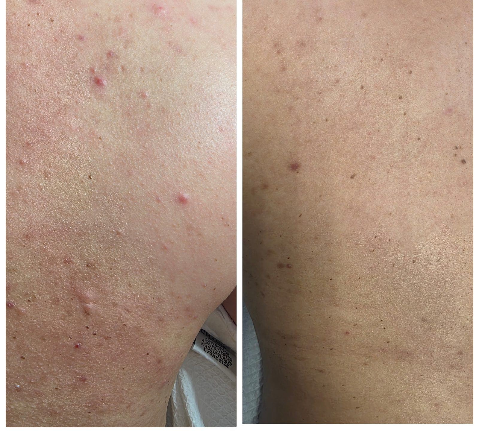 Back acne before and after at LaserTique Med Spa