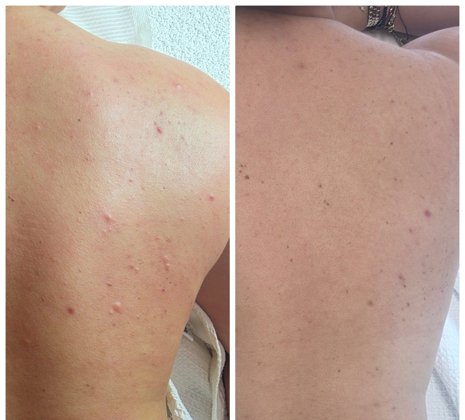 Back and shoulders before and after at LaserTique Med Spa
