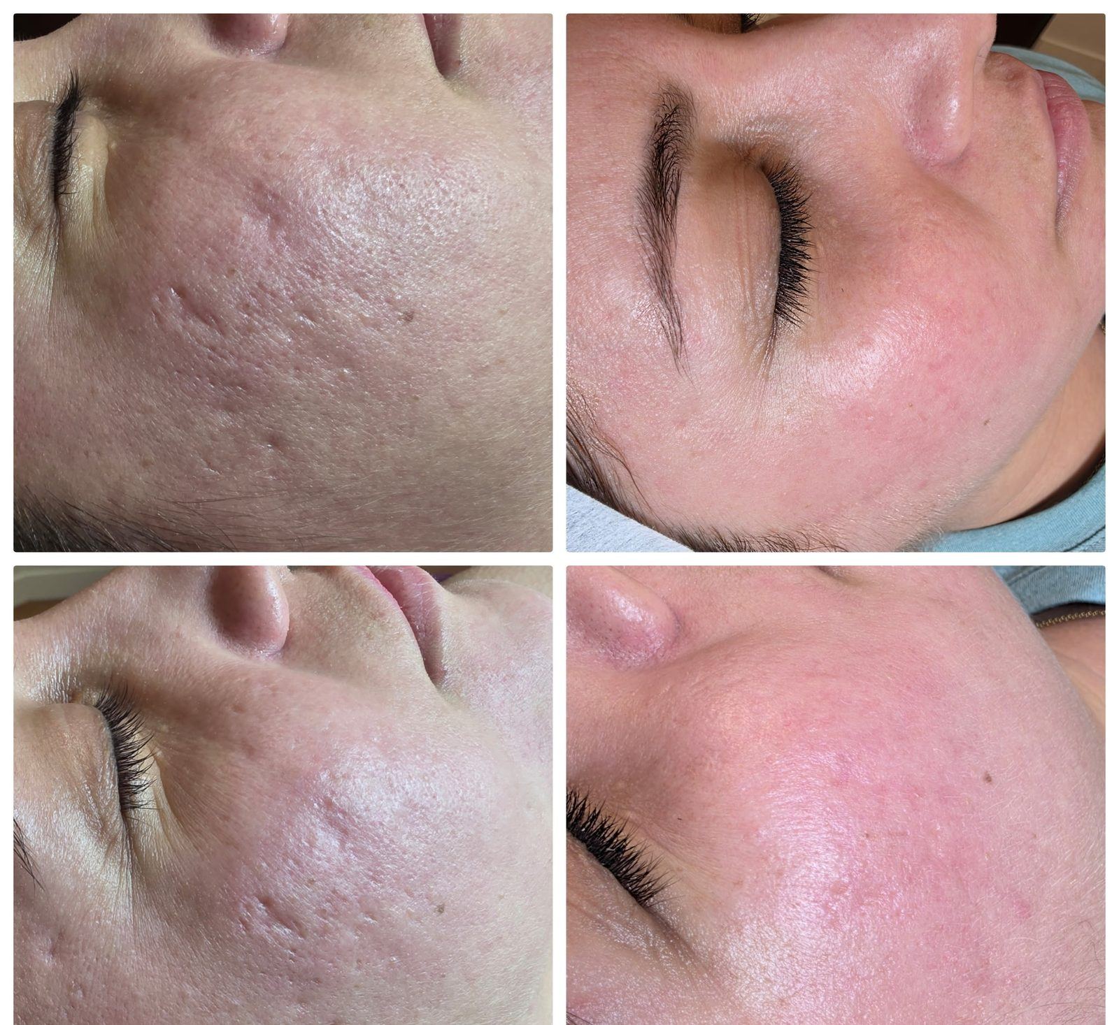 Acne scarring before and after at LaserTique Med Spa
