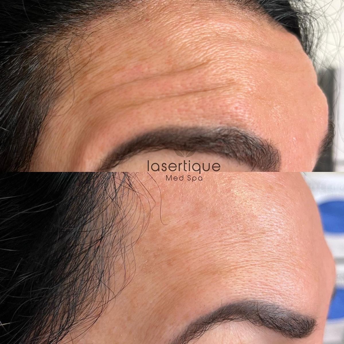 Forehead lines before and after at LaserTique Med Spa