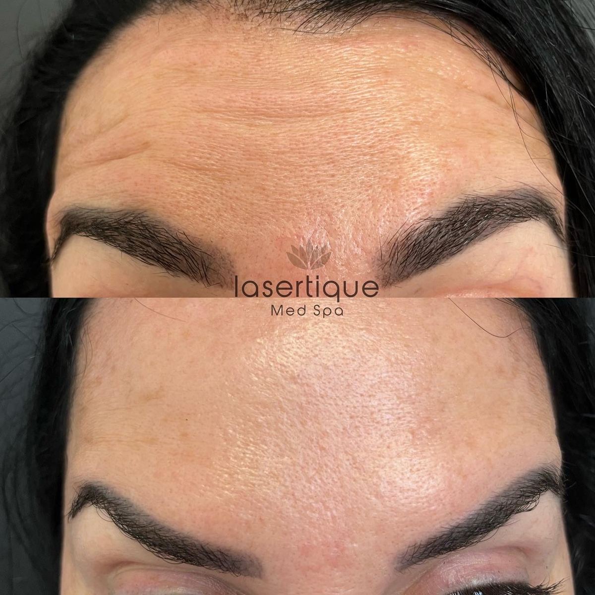 Forehead lines before and after at LaserTique Med Spa