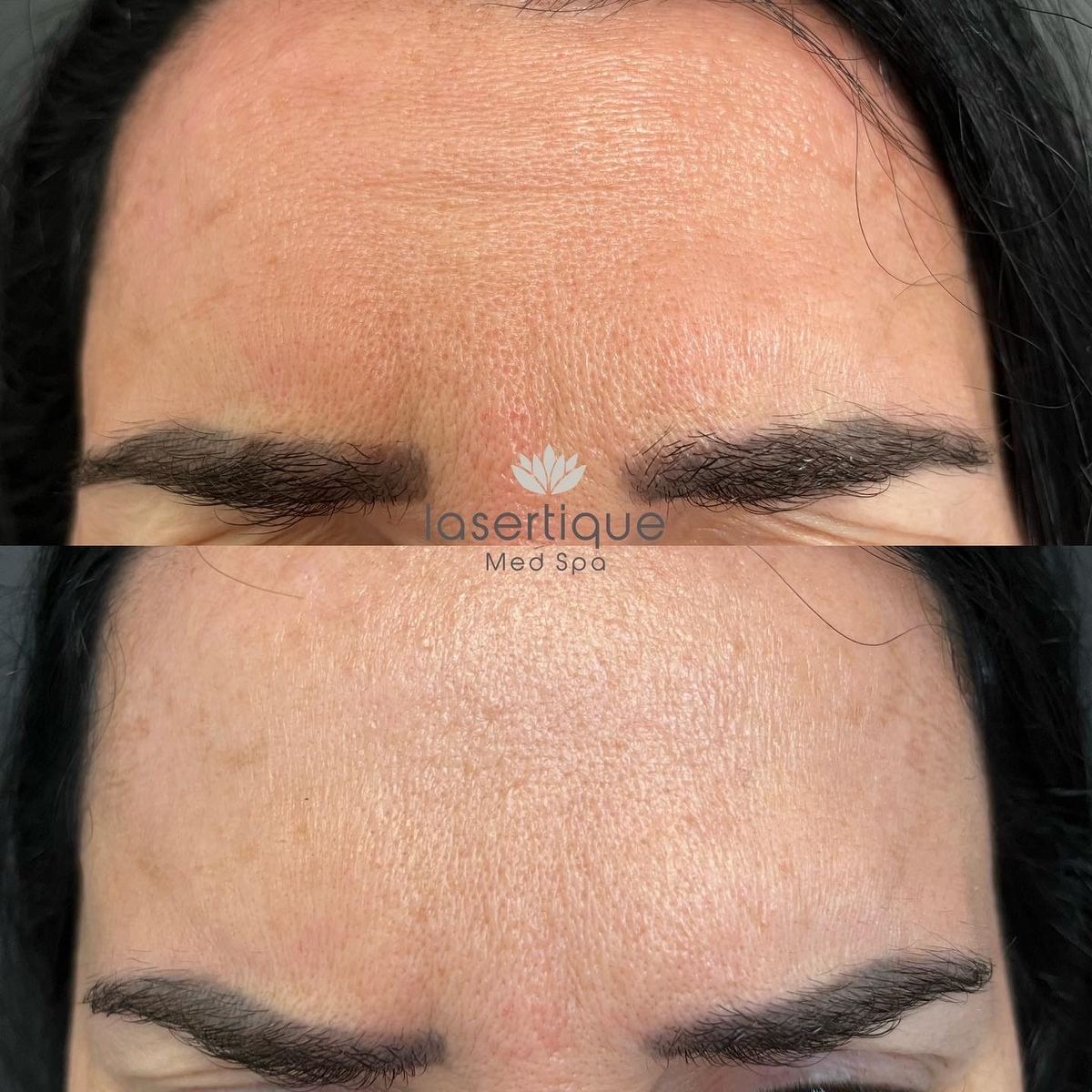 Frown lines before and after at LaserTique Med Spa