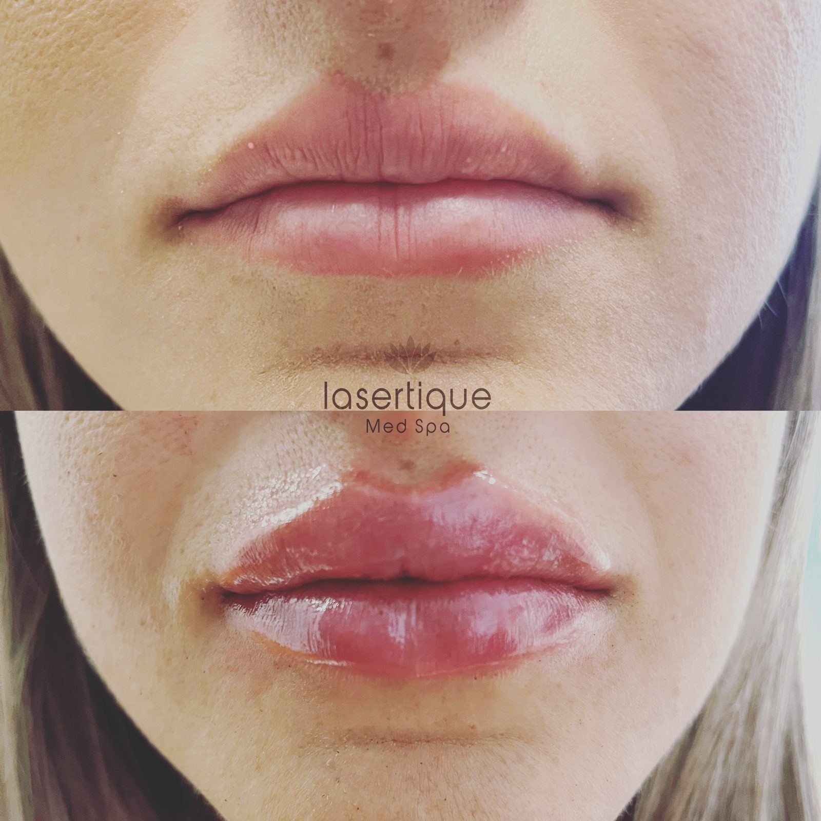 Lip augmentation before and after at LaserTique Med Spa