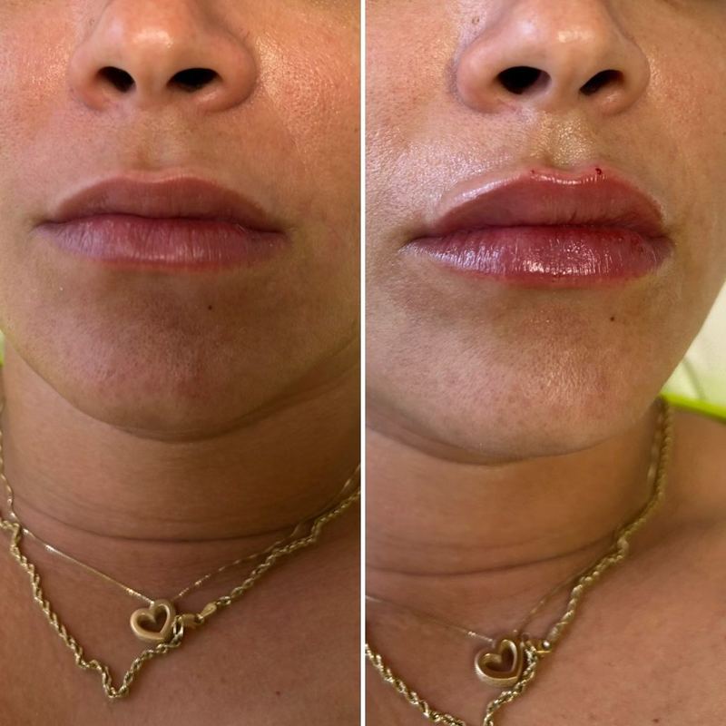 Lip augmentation before and after at LaserTique Med Spa
