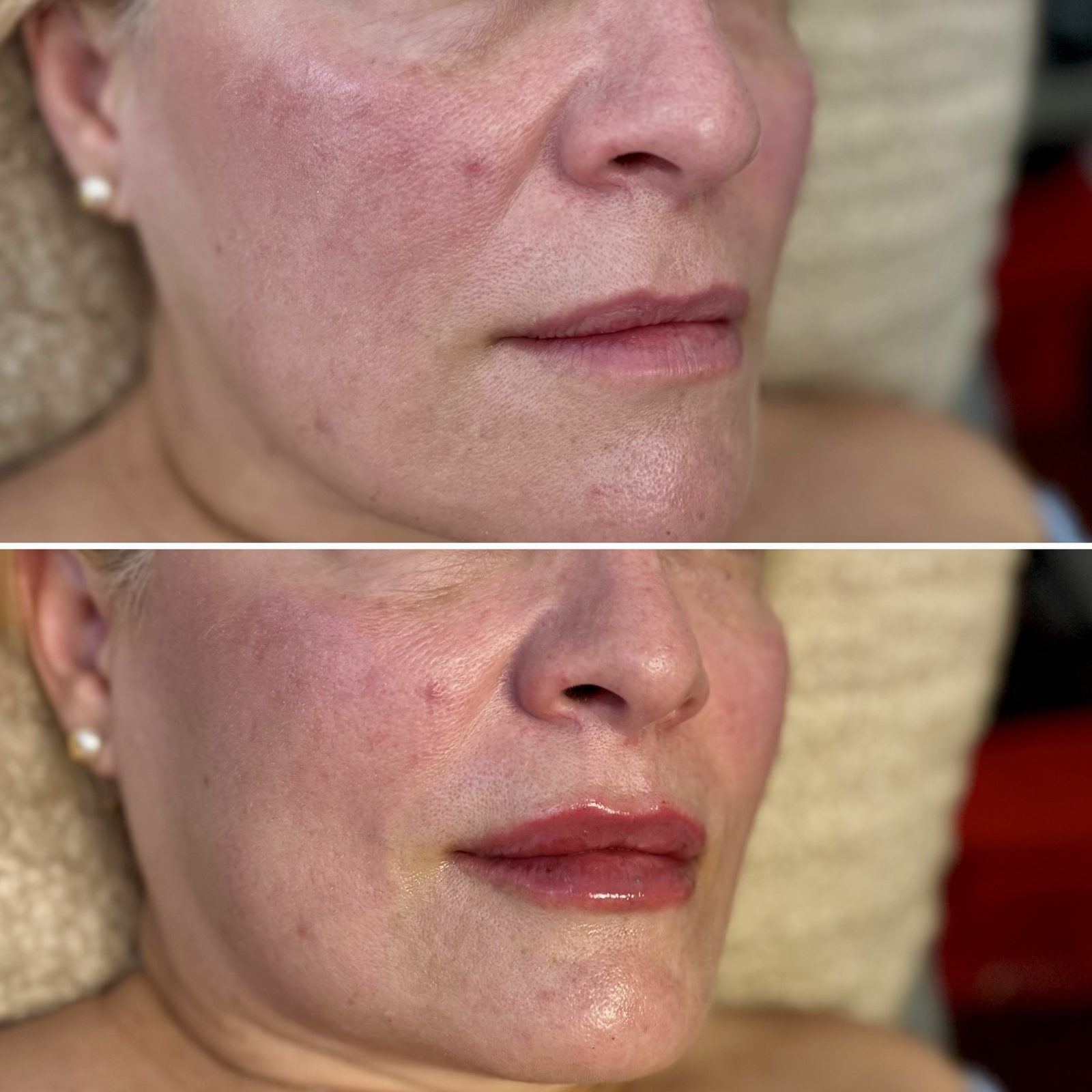 Lip augmentation before and after at LaserTique Med Spa