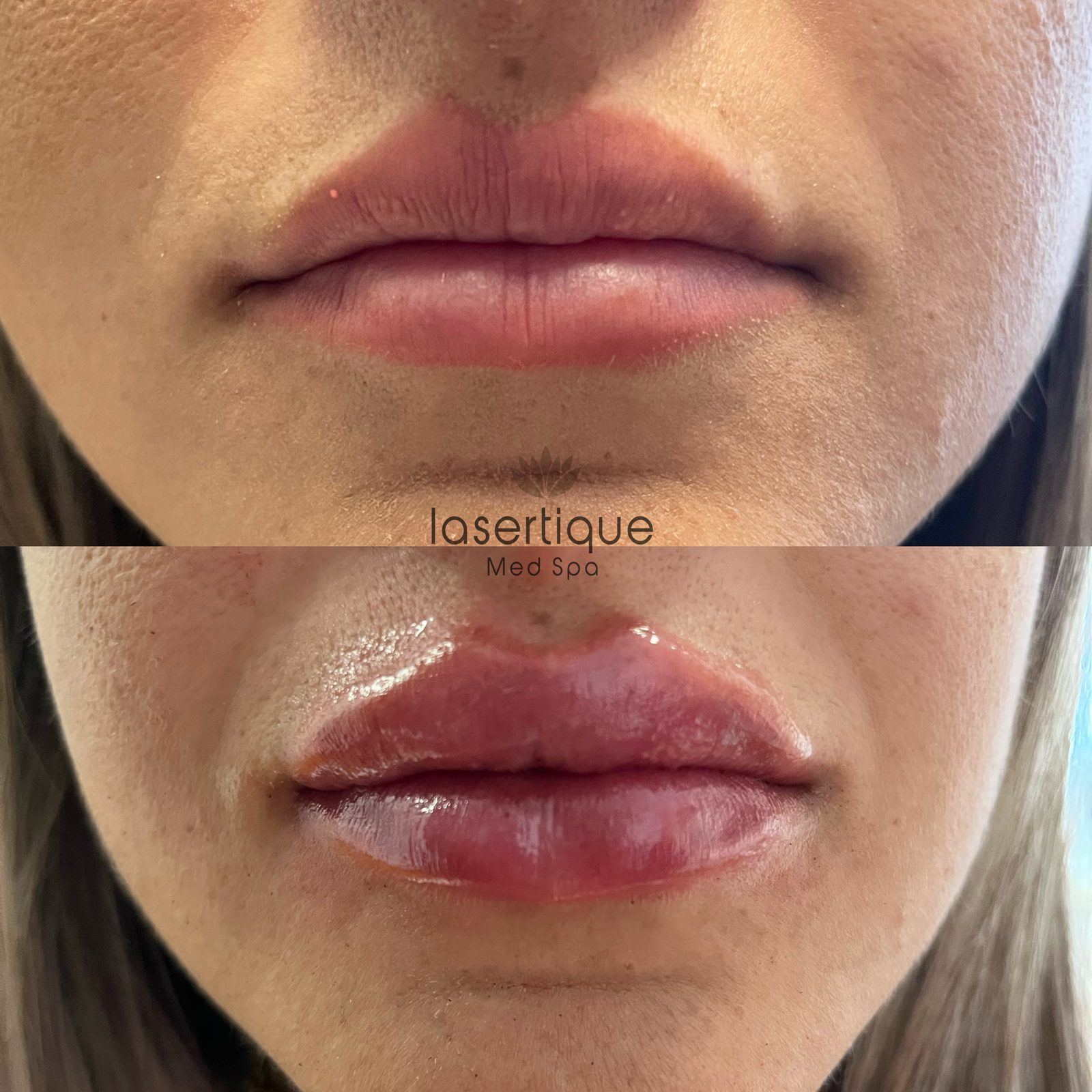 Lip augmentation before and after at LaserTique Med Spa
