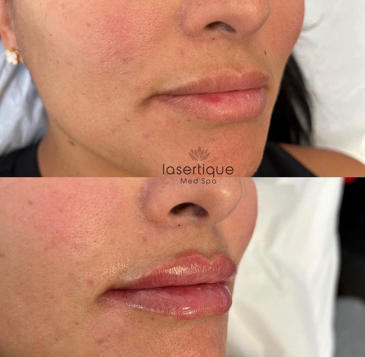 Lip augmentation before and after at LaserTique Med Spa