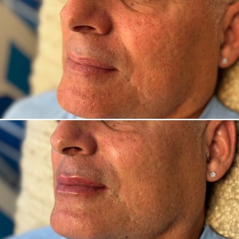 Lip augmentation before and after at LaserTique Med Spa