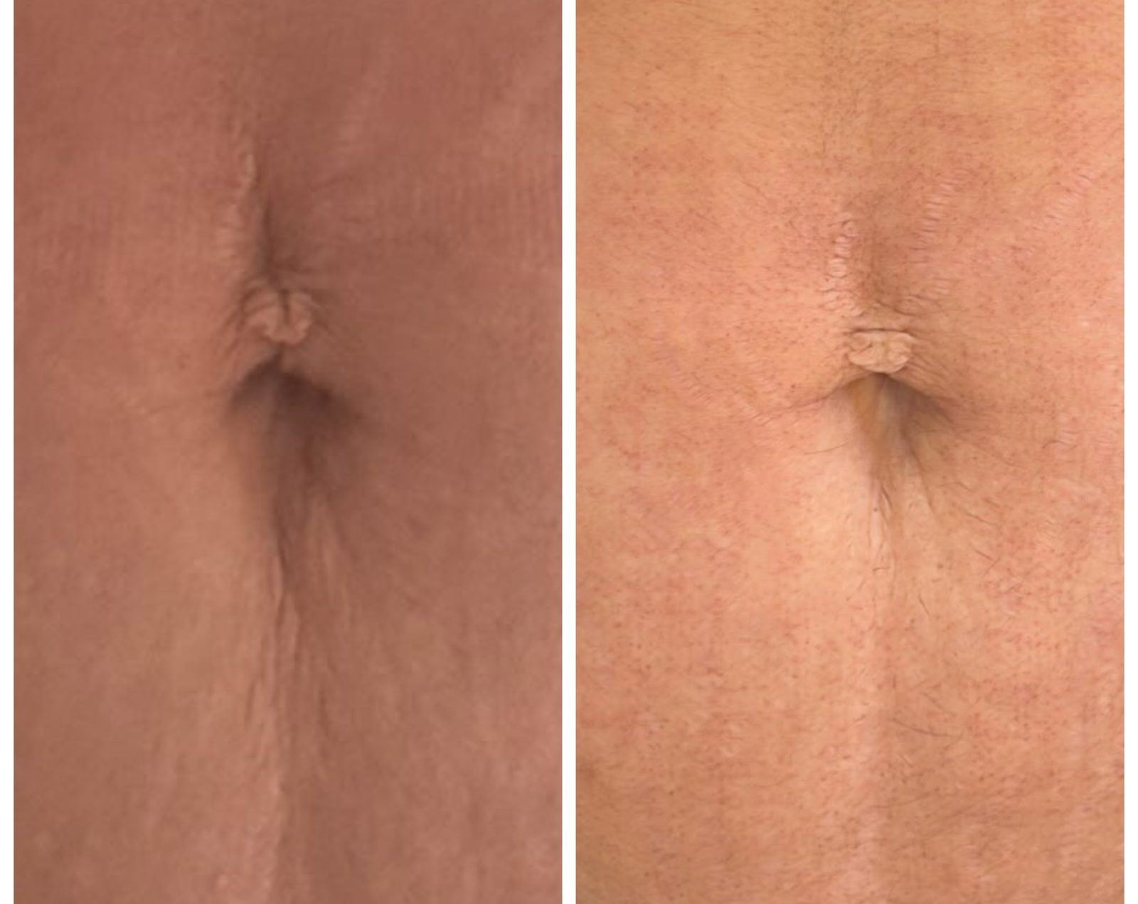 Morpheus8 — abdomen before and after at LaserTique Med Spa