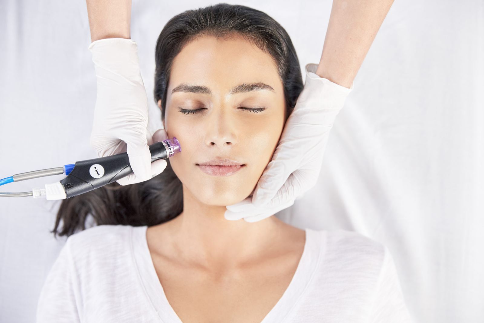 Microneedling pen treating the cheek