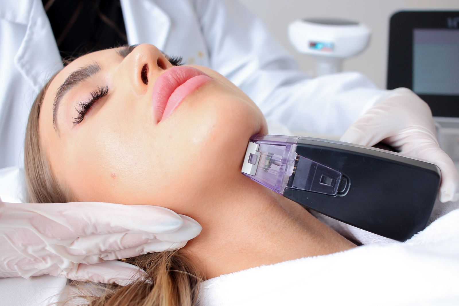 Radiofrequency microneedling handpiece along the jawline